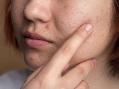 Kesalahan Skincare