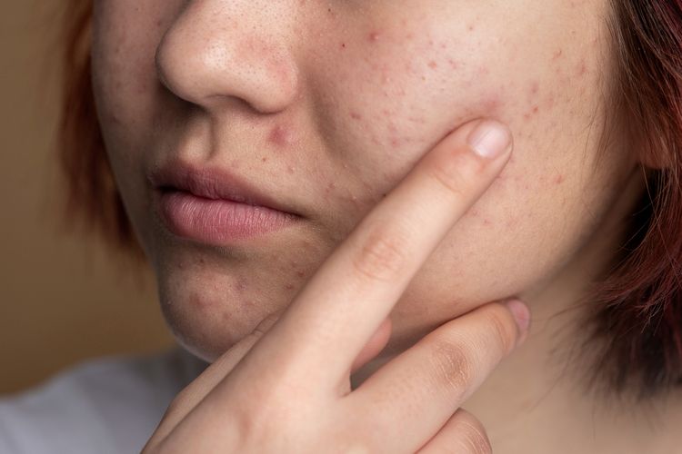 Kesalahan Skincare